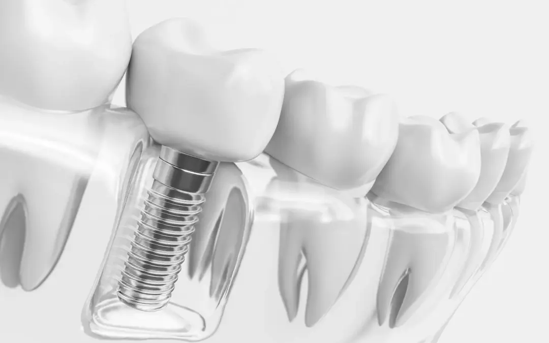 The Definitive Guide to Dental Implants: Restoring Health and Aesthetics